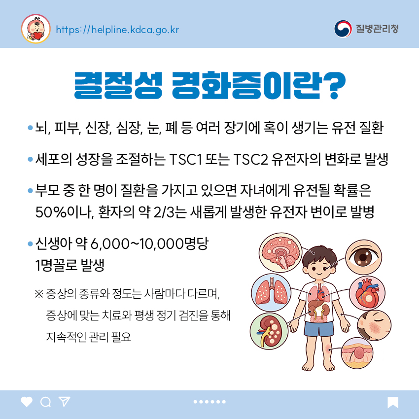 결절성 경화증이란? - 뇌, 피부, 신장, 심장, 눈, 폐 등 여러 장기에 혹이 생기는 유전 질환 - 세포의 성장을 조절하는 TSC1 또는 TSC2 유전자의 변화로 발생 - 부모 중 한 명이 질환을 가지고 있으면 자녀에게 유전될 확률은 50%이나, 환자의 약 2/3는 새롭게 발생한 유전자 변이로 발병 - 신생아 약 6,000~10,000명당 1명꼴로 발생 ※ 증상의 종류와 정도는 사람마다 다르며, 증상에 맞는 치료와 평생 정기 검진을 통해 지속적인 관리 필요
